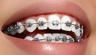 拔了八顆牙齒 矯牙后大變樣！