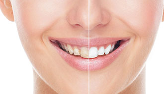 她美牙后，事業與感情兩豐收